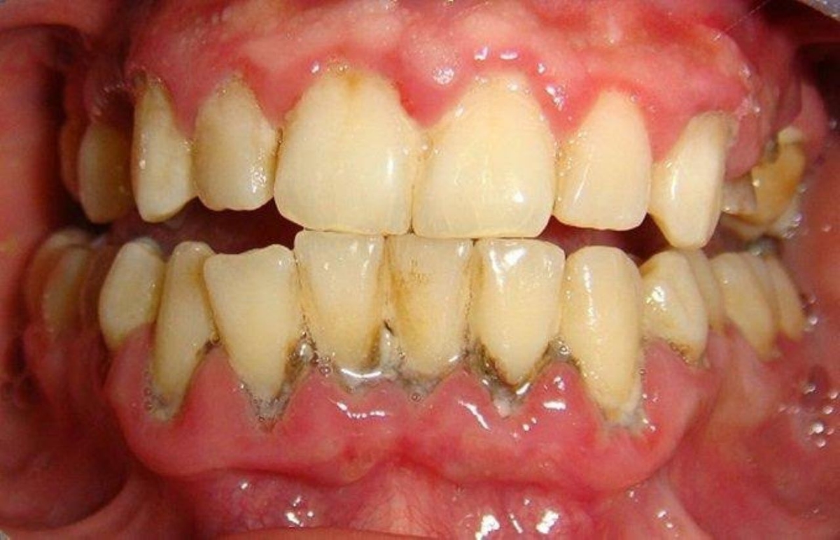 Giải đáp thắc mắc: lấy vôi răng có tác dụng gì cho ai cần biết