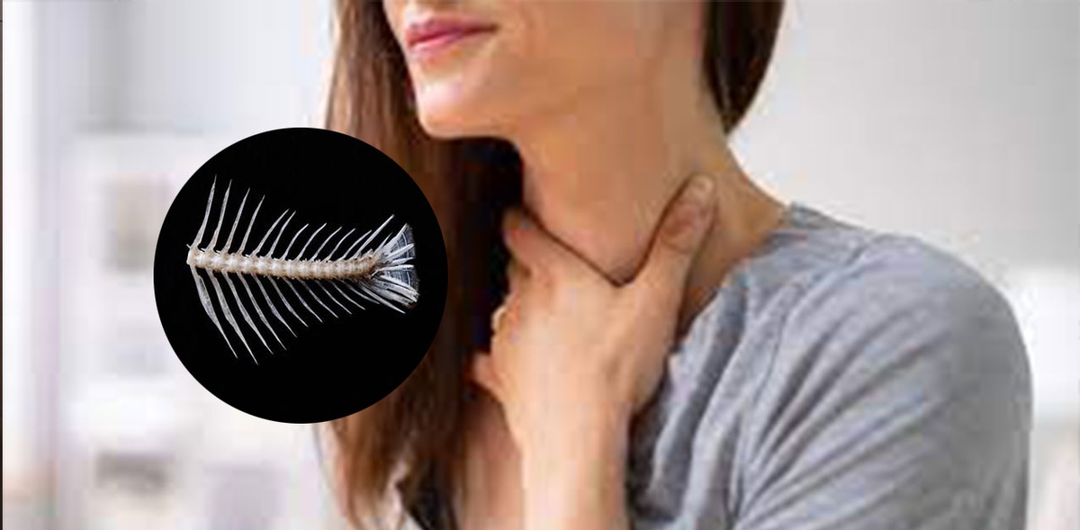 Lấy xương cá khi bị hóc sai cách &#8211; Coi chừng những hệ lụy