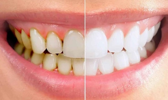 Cách loại bỏ mảng bám răng cứng đầu nhanh chóng