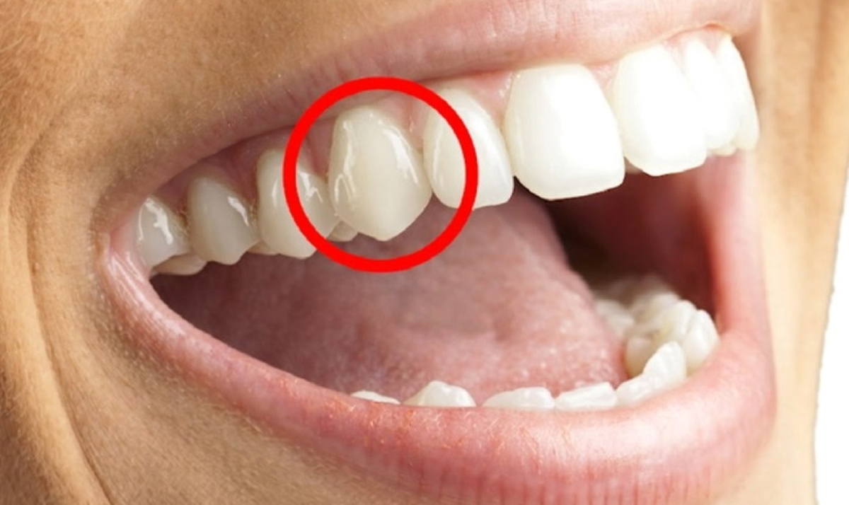 Mài 2 răng nanh nhọn và những ảnh hưởng