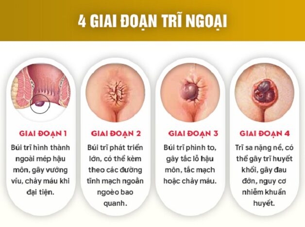 Các cấp độ trĩ ngoại