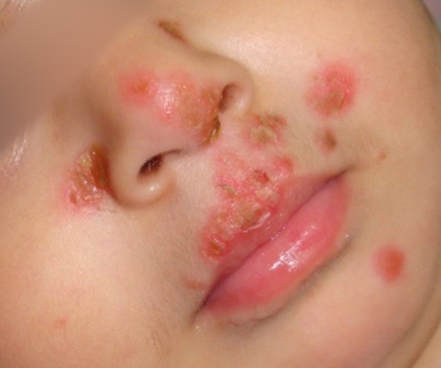 bệnh mụn rộp quanh miệng