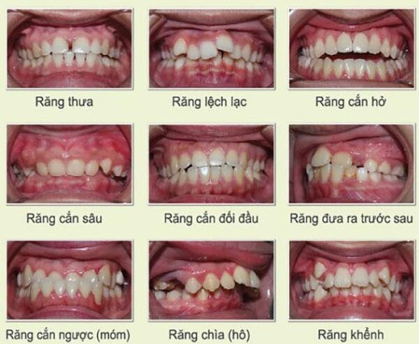 Giải đáp có nên nẹp răng cửa không 