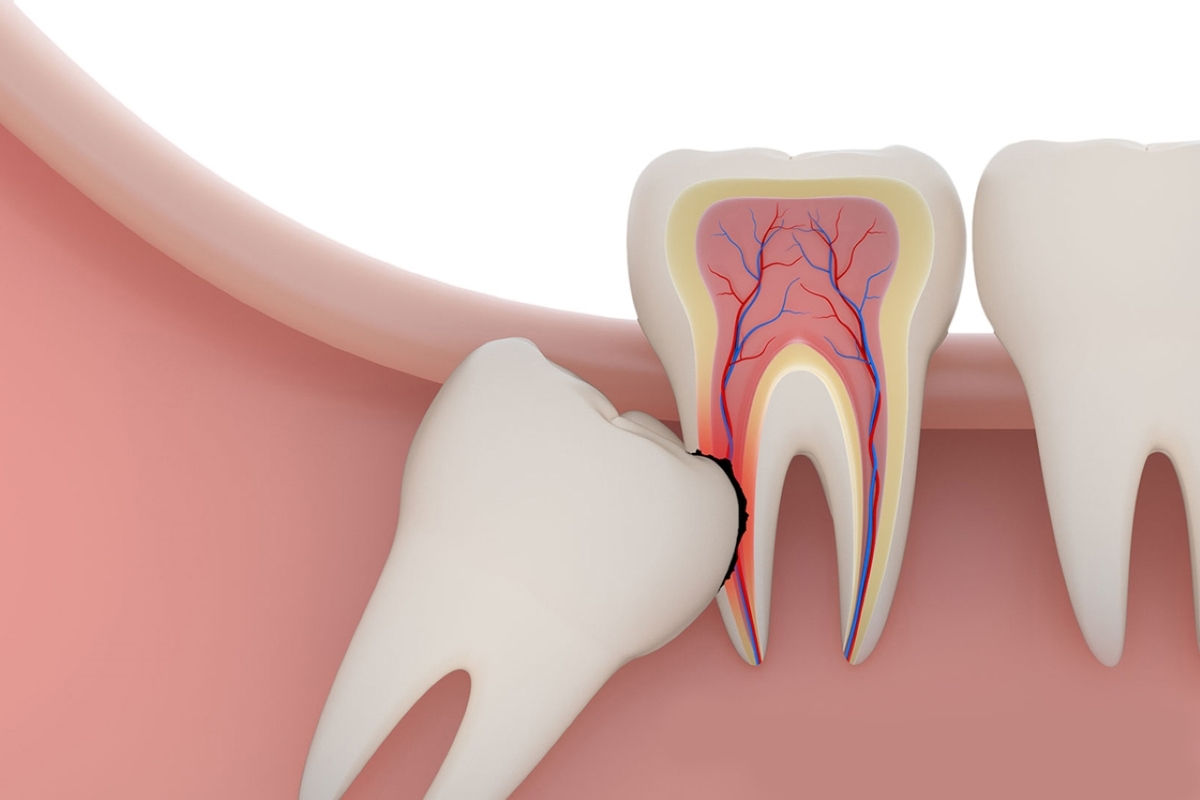 Những ảnh hưởng từ nhổ răng khôn không khâu