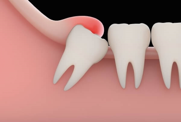 Đối với những bệnh nhân mắc tiêu đường, bệnh tim mạch, ... không nên thực hiện nhổ răng khôn