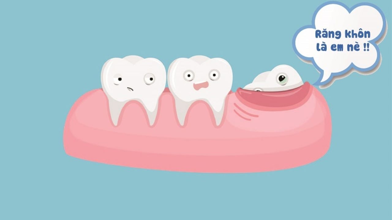 Review kinh nghiệm nhổ răng khôn ở đâu uy tín