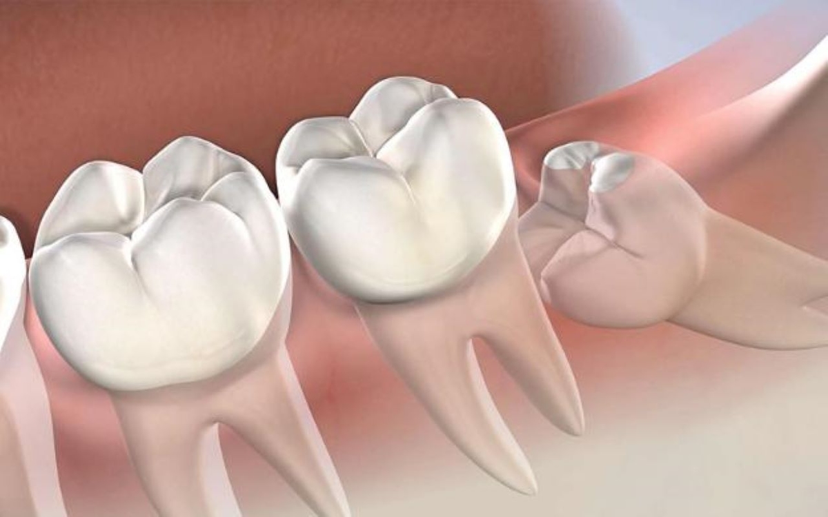 Nhổ răng khôn tại Hà Nội đừng bỏ qua những điều này