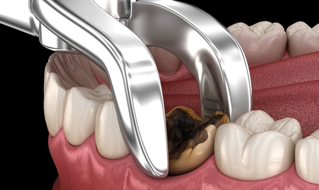 Nhổ răng sâu có mọc lại không và những lưu ý