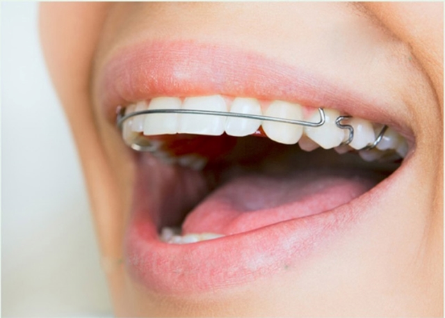 Hô hàm có niềng răng được không và những lưu ý