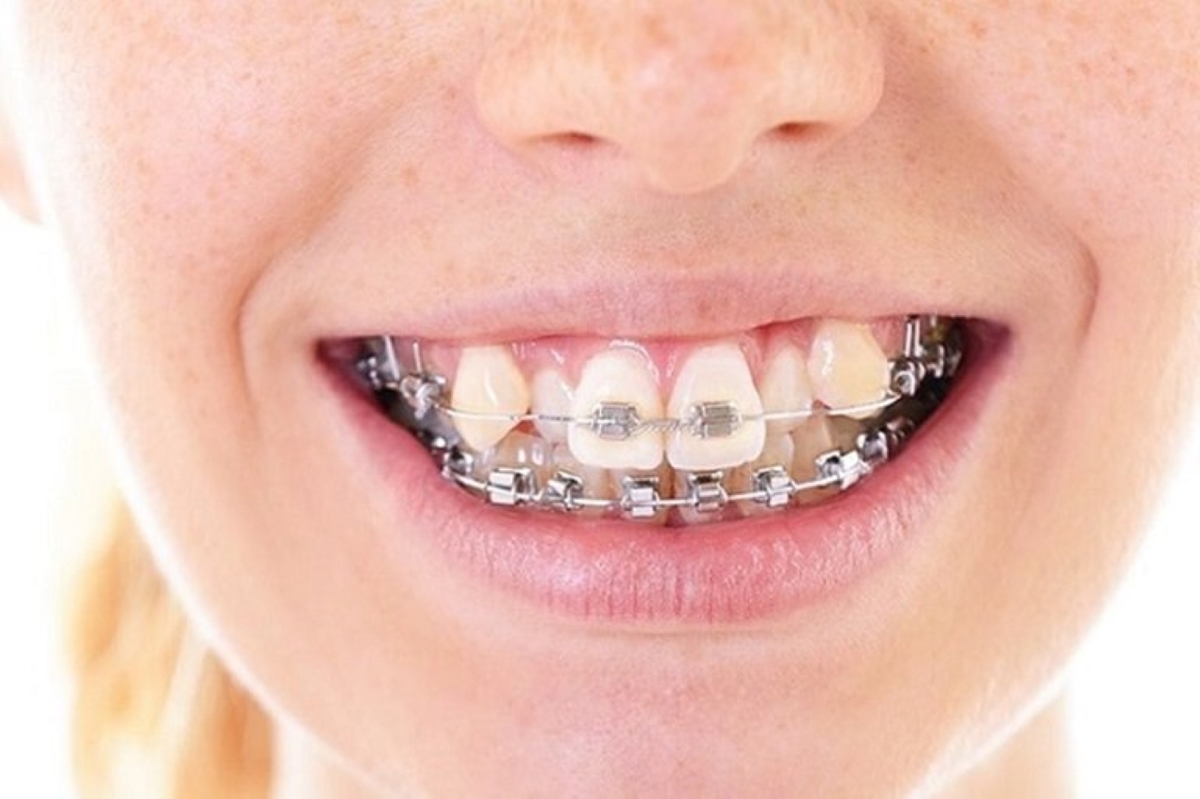 Tìm hiểu về niềng răng khểnh như thế nào