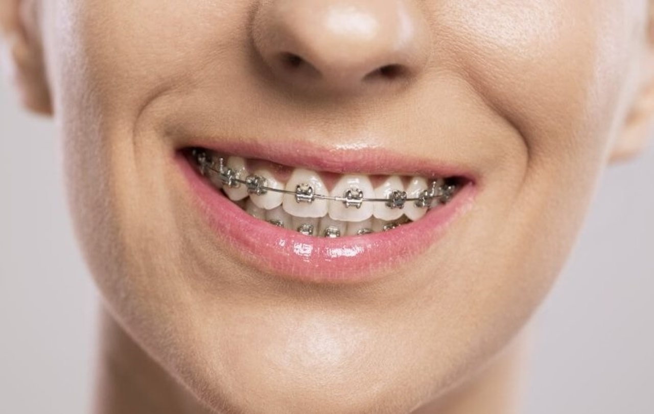 Niềng răng lệch hàm và những điều cần biết