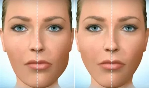 Lệch hàm nếu không điều trị có thể ảnh hưởng đến sức khỏe