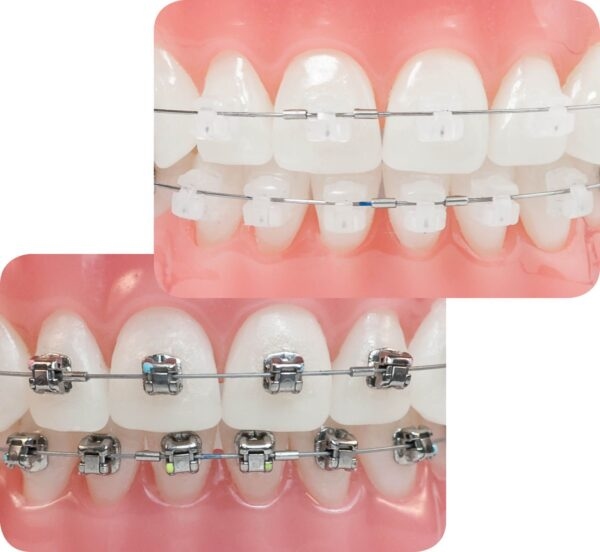 Phân loại mắc cài sứ trong niềng răng thẩm mỹ