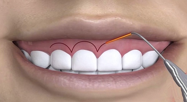 phẫu thuật cắt lợi bao nhiêu tiền