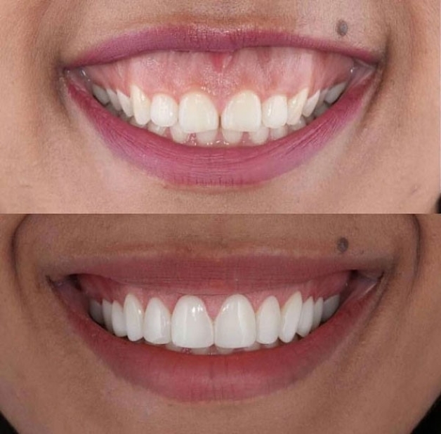 phẫu thuật cười hở lợi ở đâu tốt