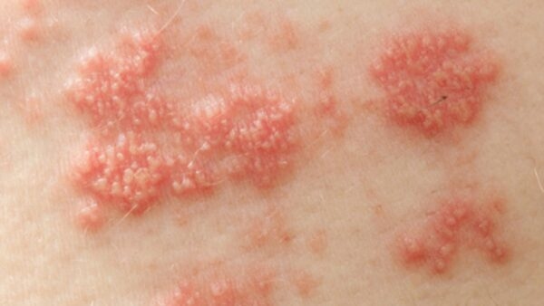 Bệnh sùi mào gà do virus HPV