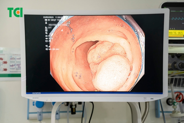 Polyp đại tràng có gây táo bón không? Điều trị ra sao?