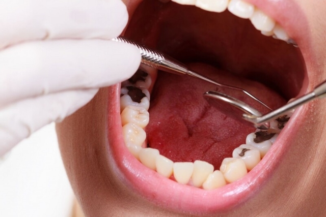 Sự phát triển của quá trình sâu răng
