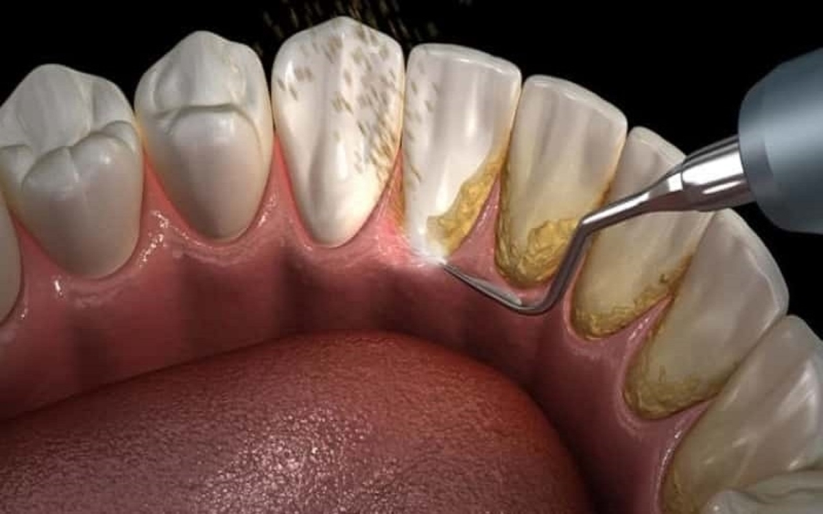 Răng bị bám vôi và những ảnh hưởng nghiêm trọng
