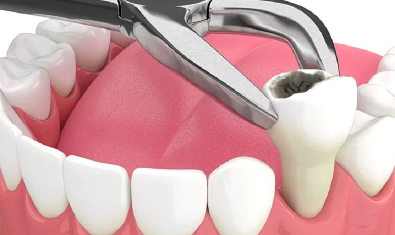 Mức độ nguy hiểm của nhổ răng cấm bị sâu nặng