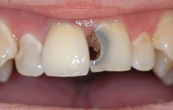 Vệ sinh răng miệng chưa đúng cách là nguyên nhân khiến răng cửa bị sâu