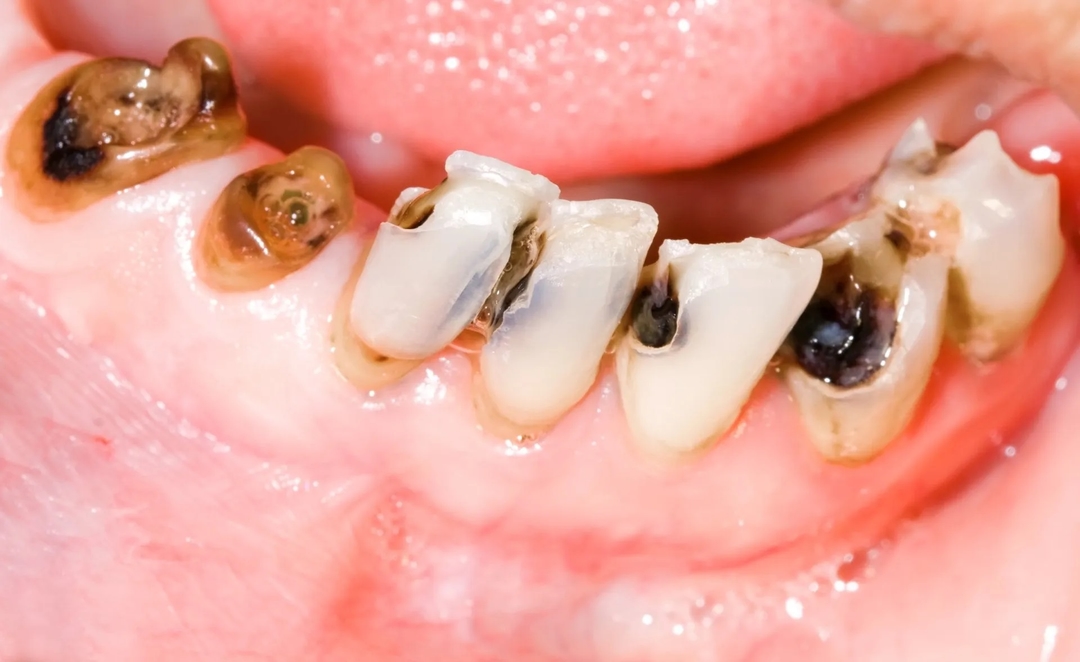 Những việc nên làm khi răng cửa bị sâu đen