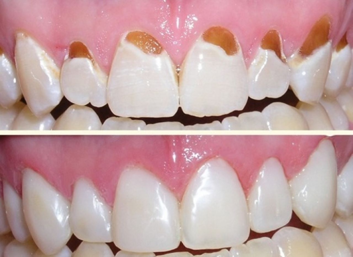 Cách xử lý răng cửa bị sâu và mẻ tối ưu chi phí đảm bảo thẩm mỹ