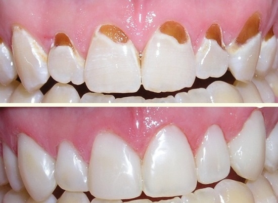 răng cửa bị sâu và mẻ
