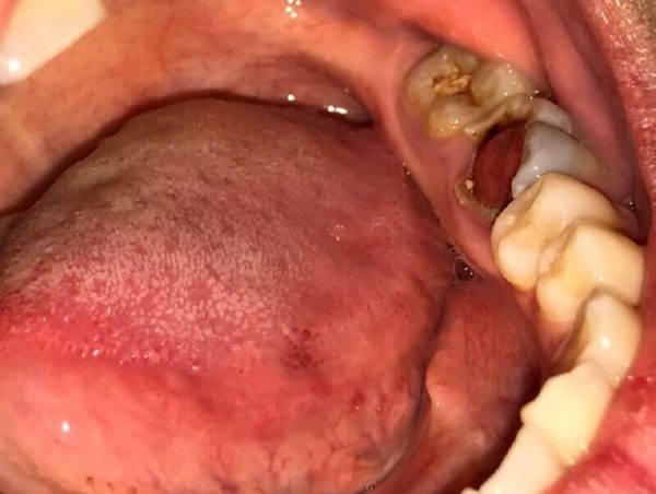 Răng sâu mọc thịt là tình trạng khá nặng