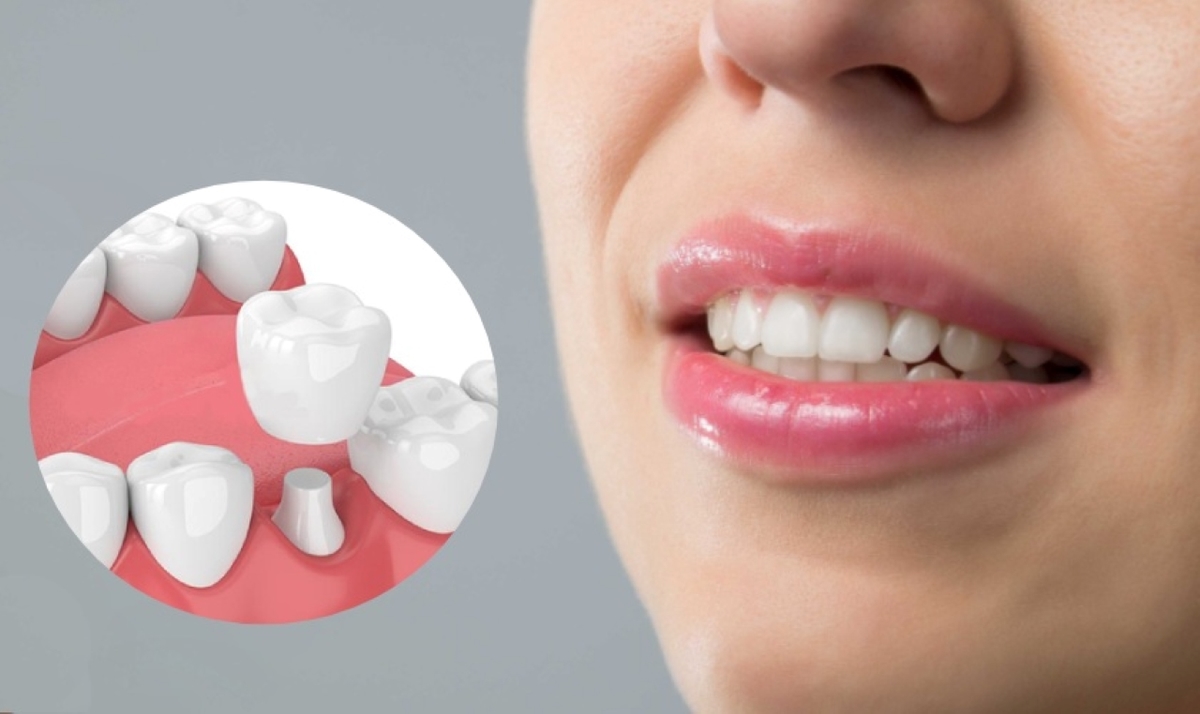 Răng sứ cao cấp Zirconia và những ưu điểm nổi bật