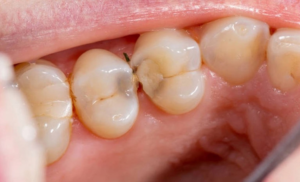 Sâu răng bên hông và những điều cần biết