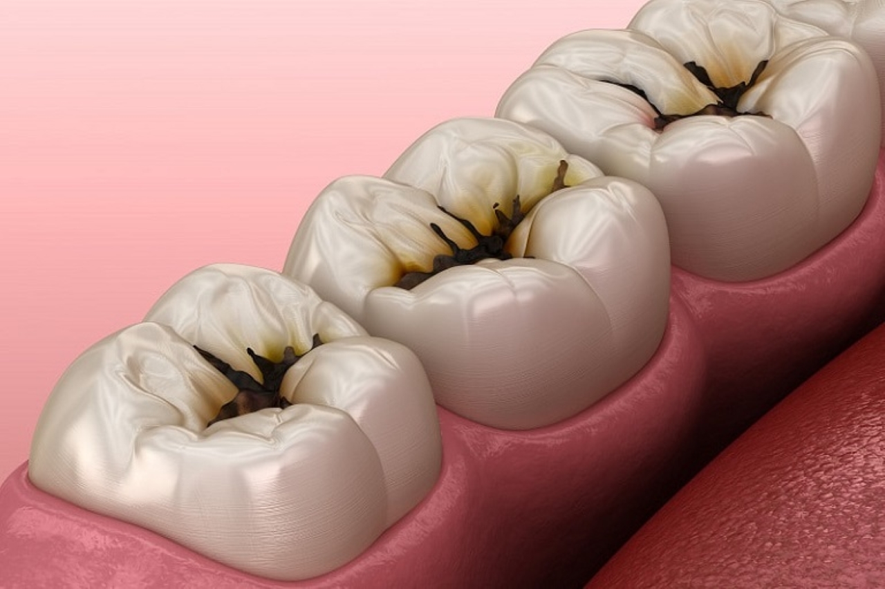 Cách xử lý triệt để khi bị sâu răng cấm