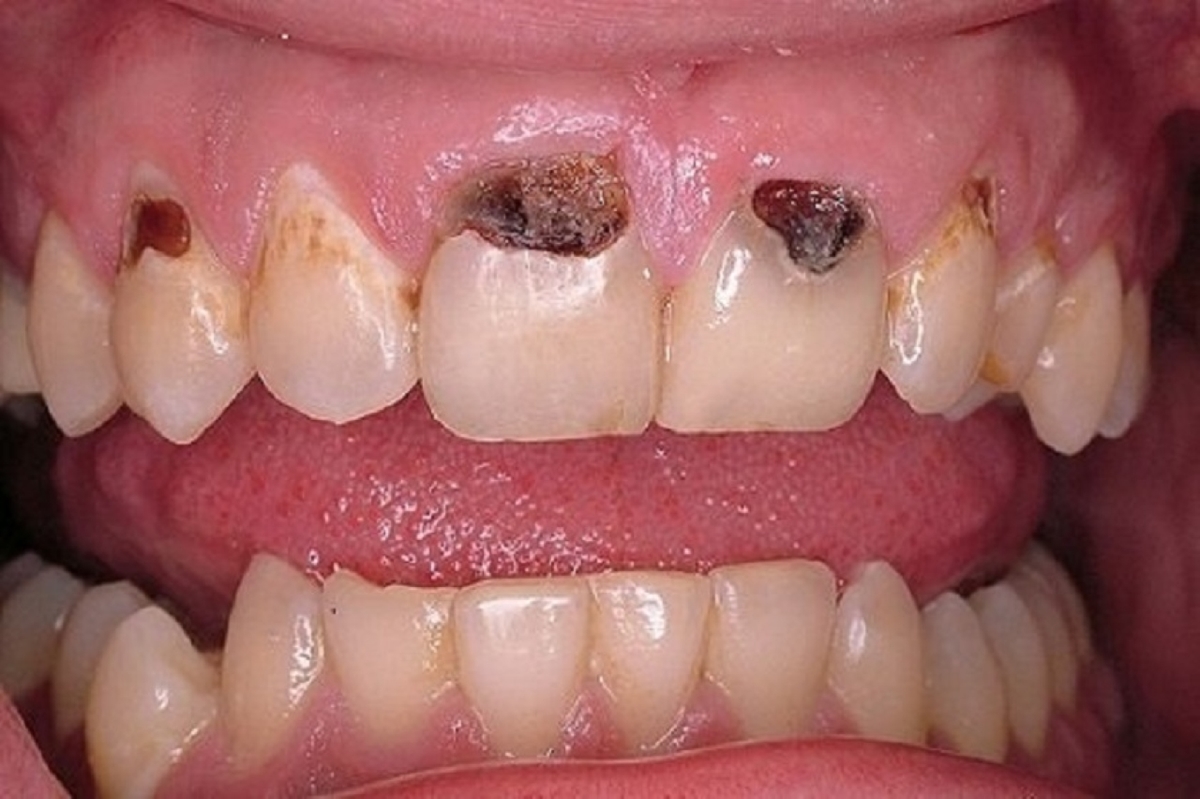 Sâu răng cửa ở người lớn và cách xử trí