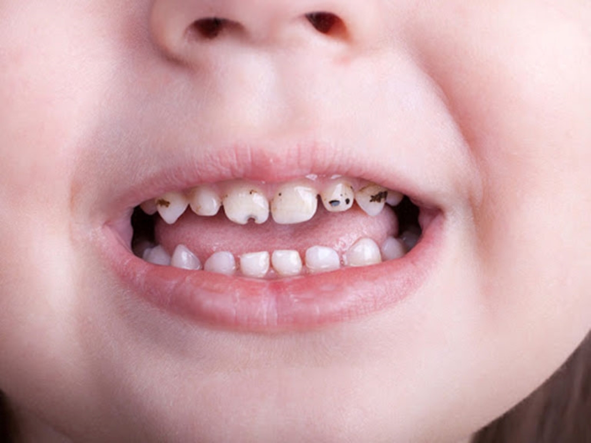 Sự thật về việc sâu răng di truyền