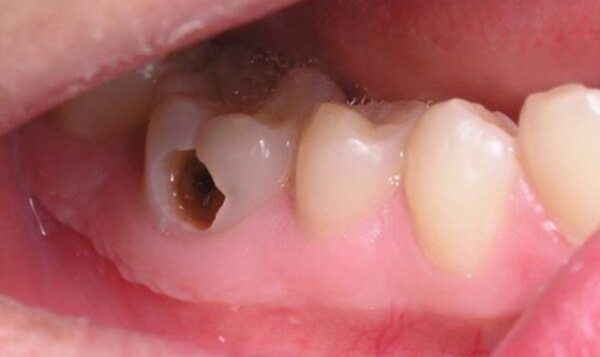 sâu răng đục lỗ
