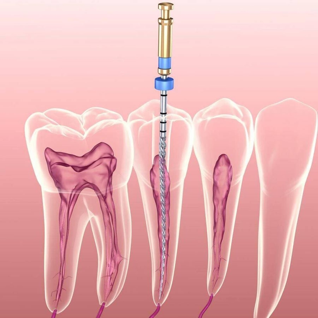 Sâu răng lấy tủy và những lưu ý