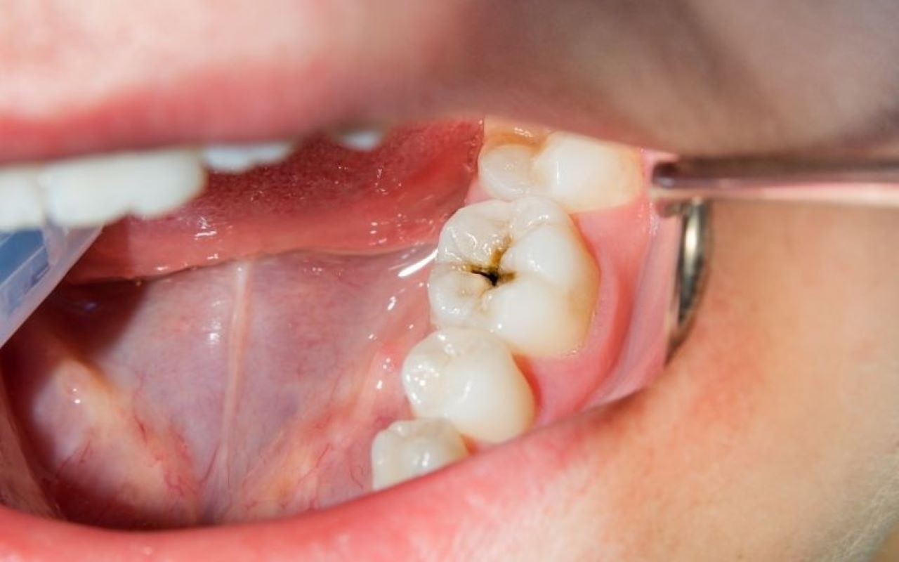 Cách xử lý sâu răng mới chớm an toàn và dễ dàng