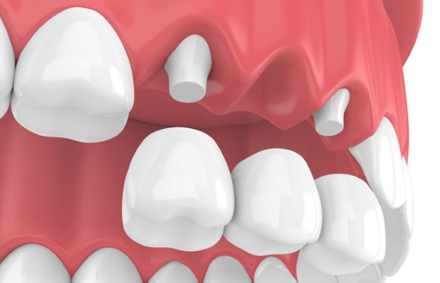 răng số 5 bị sâu