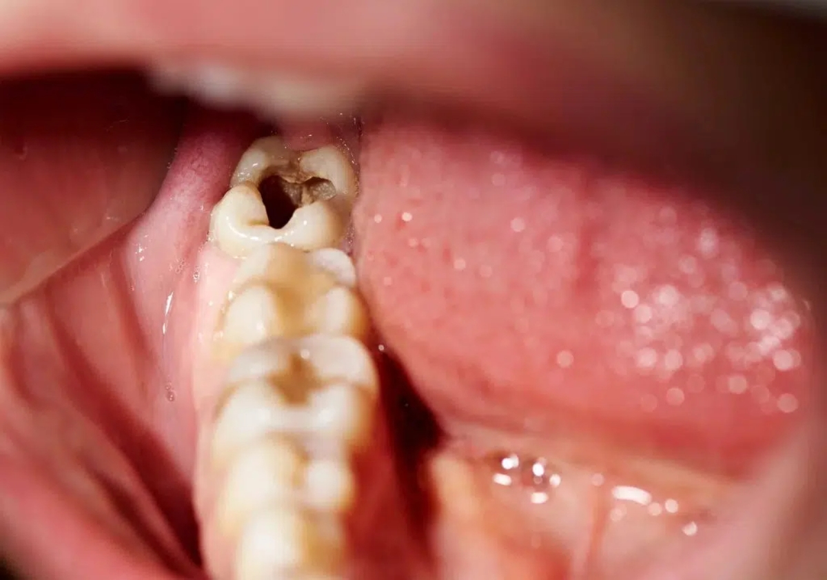 Giải đáp chi tiết: Sâu răng từ đâu ra?