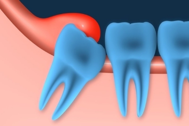 Dấu hiệu và nguyên nhân của sưng lợi răng trong cùng