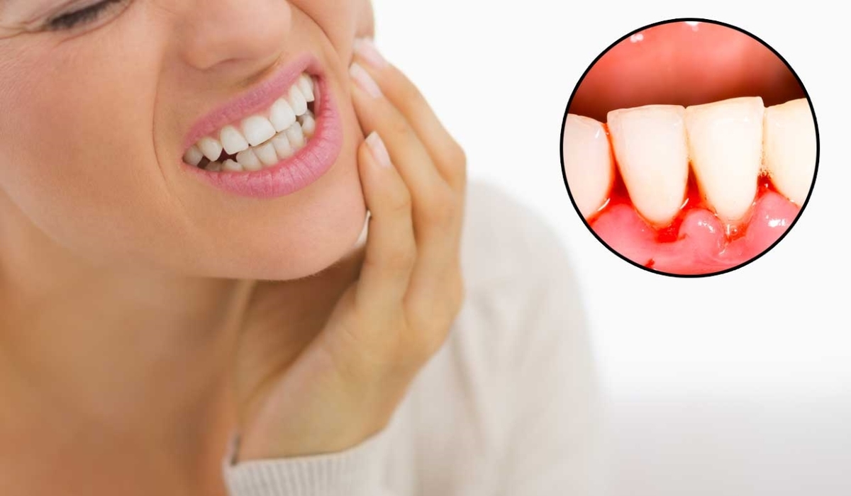 Tẩy vôi răng bị chảy máu có nguy hiểm và lưu ý