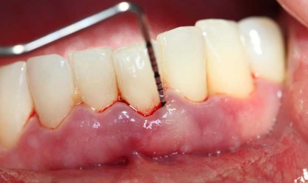 Chảy máu sau tẩy vôi răng
