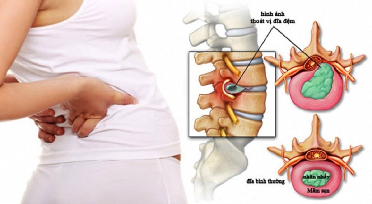 Thoát vị đĩa đệm ở người trẻ và cách điều trị