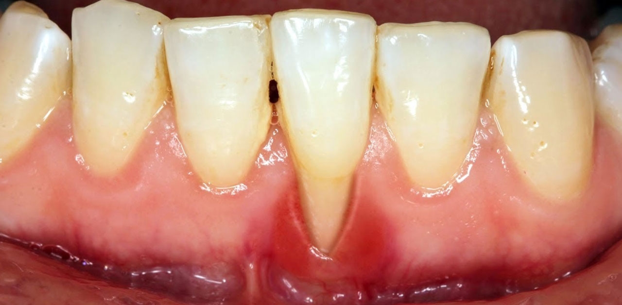 Khám phá các thuốc chữa viêm lợi tụt lợi