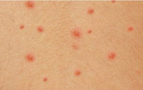 Giải đáp trẻ mắc bệnh thủy đậu khi nào hết lây-2