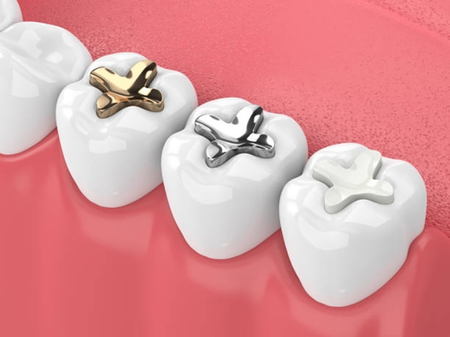 Tìm hiểu về trám răng sâu lỗ nhỏ