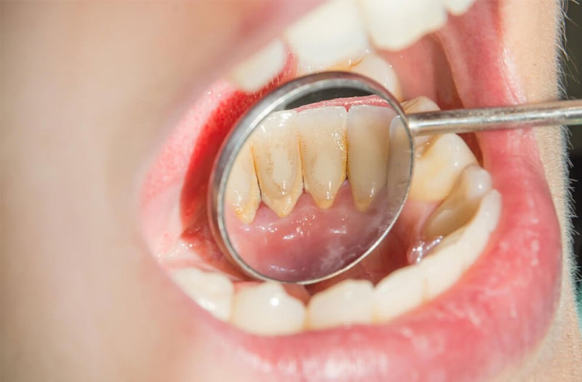Những nguy cơ khi trị cao răng tại nhà