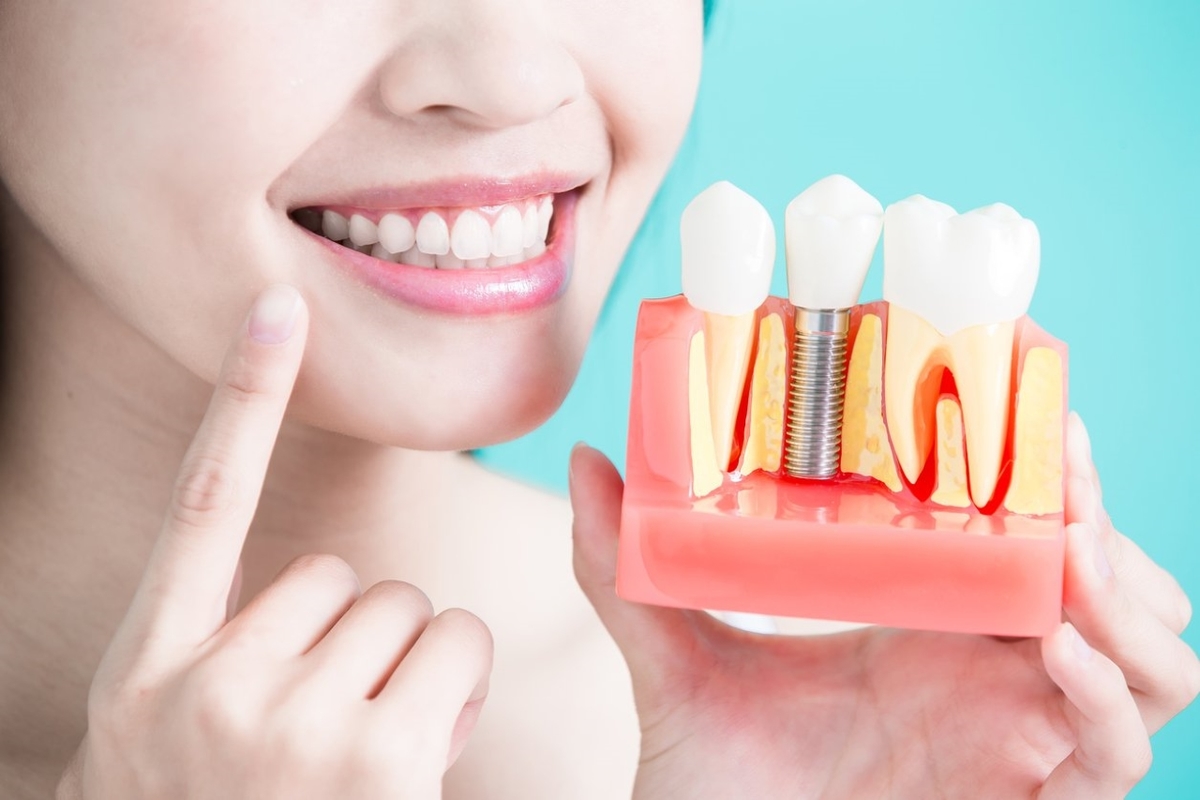 Trồng răng có đau không và những điều cần biết
