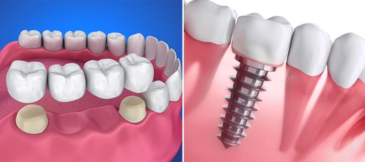Những điều cần biết về trồng răng cố định