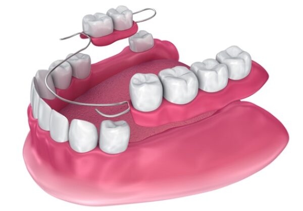 Hàm giả tháo lắp là phương pháp trồng răng truyền thống không đòi hỏi kỹ thuật cao